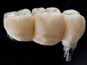 Síntomas de rechazo de un implante dental: cómo identificar posibles complicaciones