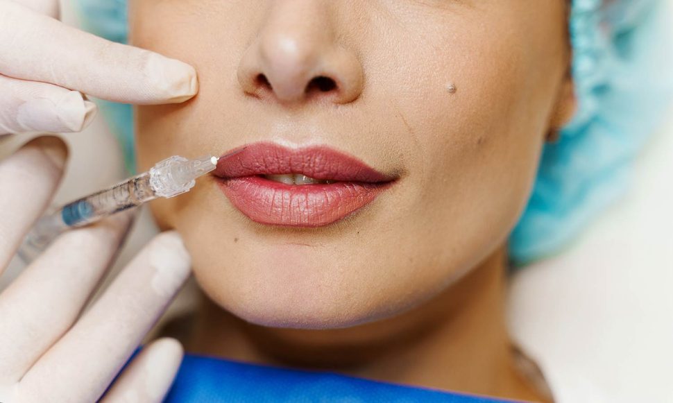 Inyección de ácido hialurónico en una mujer para rellenar los labios