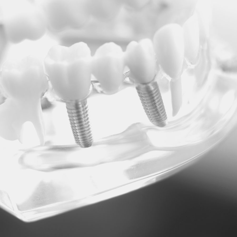 Beneficios de los implantes dentales