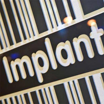 beneficios-implantes-dentales