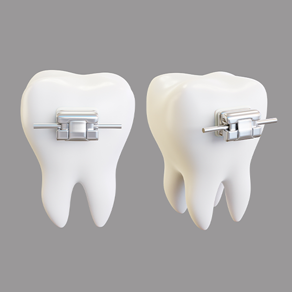 Brackets de autoligado metálicos