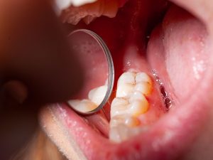 Caries interproximales: cómo detectarlas y prevenirlas