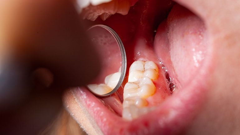 caries interproximales