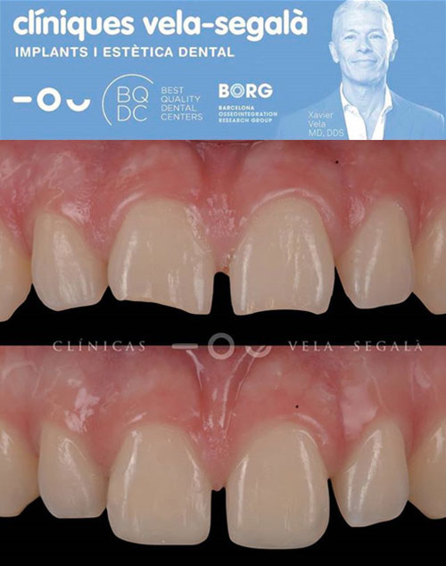 caso-clinico-carillas-composite