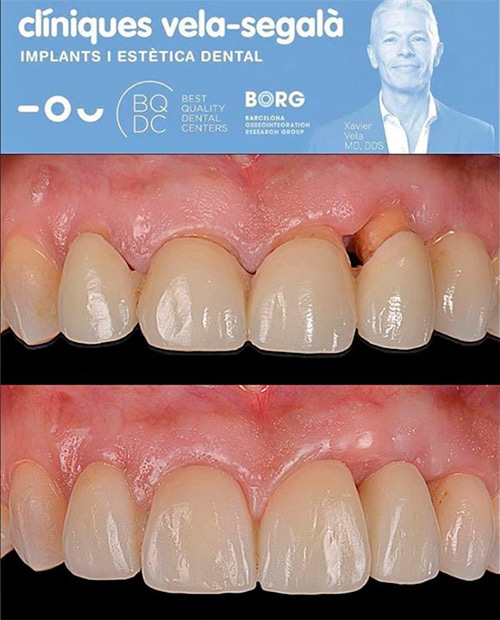 caso-clinico-coronas-dentales