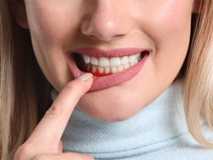 ¿Qué es un curetaje dental?