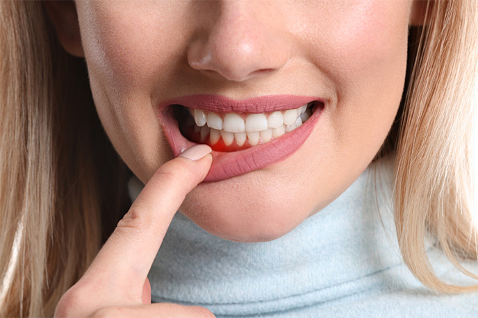 Una paciente presenta un enrojecimiento e inflamación en las encías. Puede que necesite un curetaje dental.