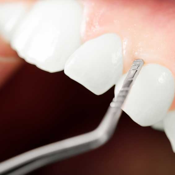 Enfermedades Periodontales