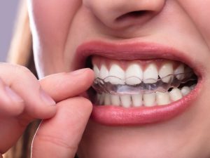 ¿Aprietas los dientes sin darte cuenta? Causas y soluciones efectivas