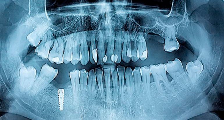 imlantes-dentales-barcelona