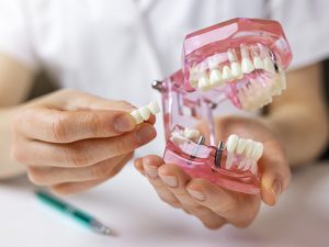 ¿Pueden los implantes dentales dar problemas? | Formas de solucionarlos