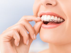 Cómo limpiar la ortodoncia invisible