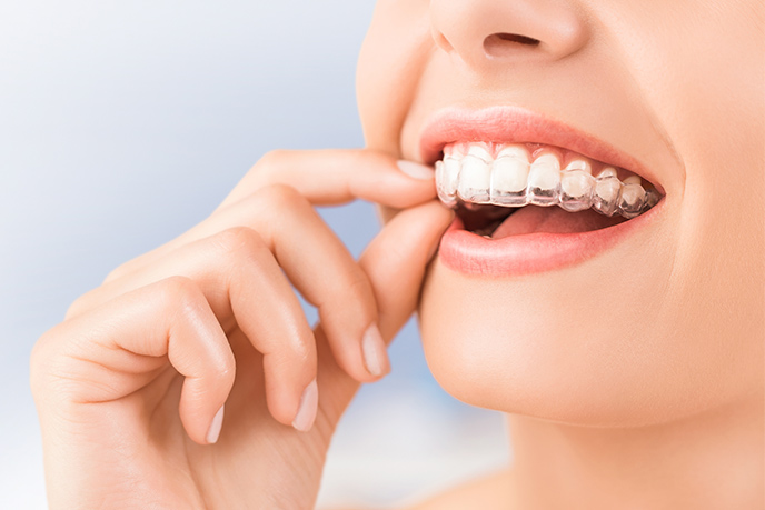 Limpiar la ortodoncia invisible ayudará a que el tratamiento mantenga su eficacia.