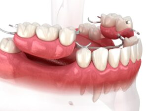 Prótesis dentales fijas sin implantes, ¿son una opción para ti?