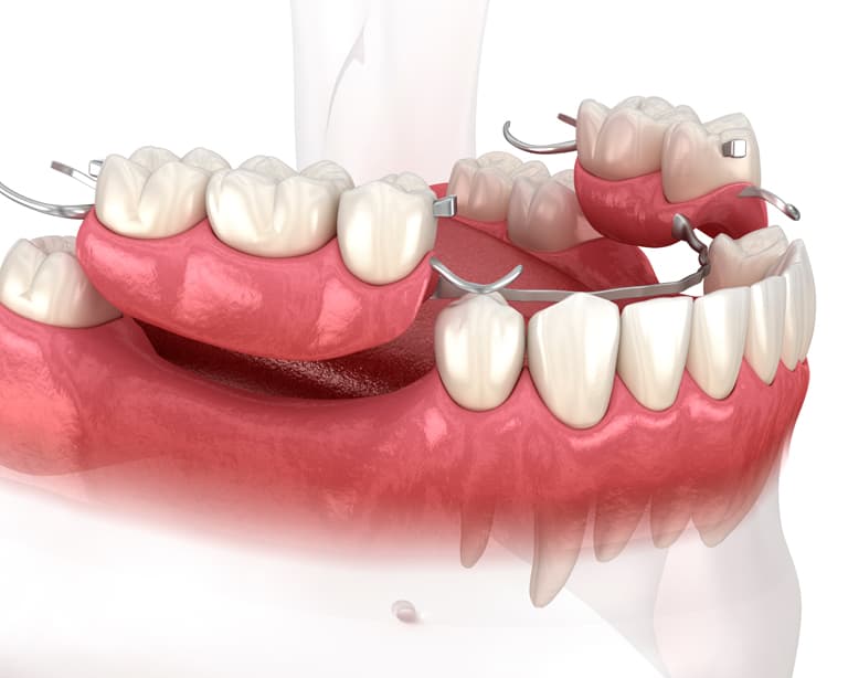 protesis dentales fijas sin implanes opciones