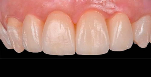 Restauración con cerámica en un paciente periodontal