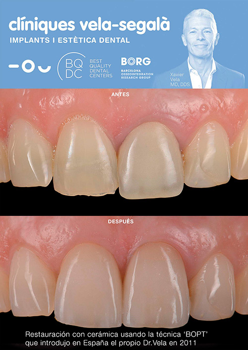restauracion-ceramica