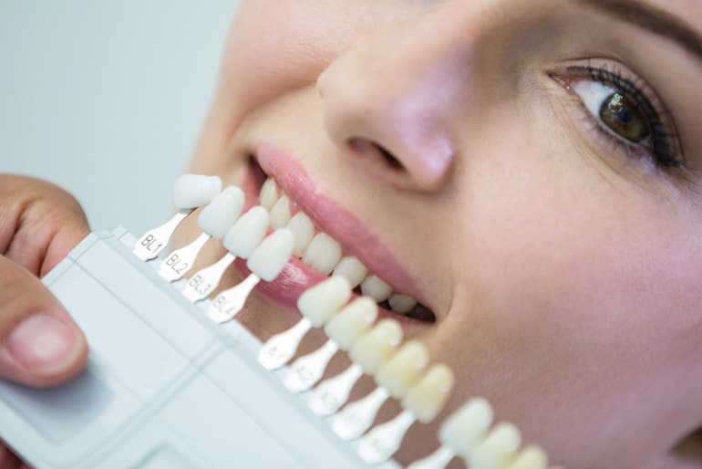 tipos de carillas dentales paciente