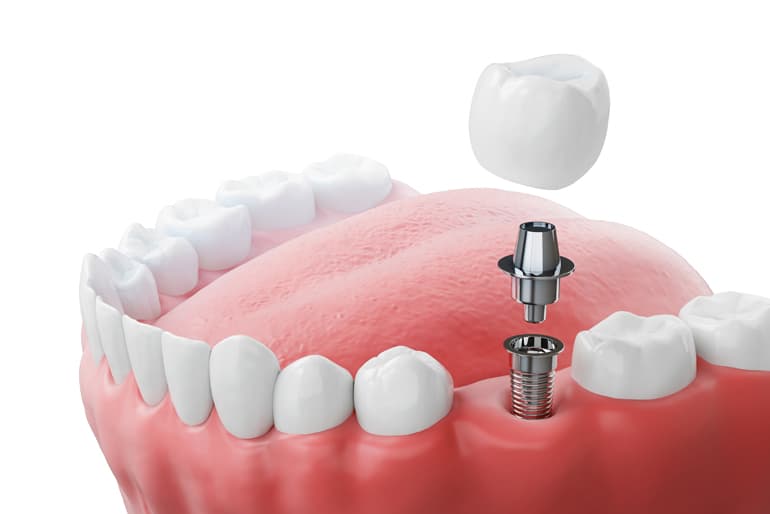 tipos de implantes dentales que existen